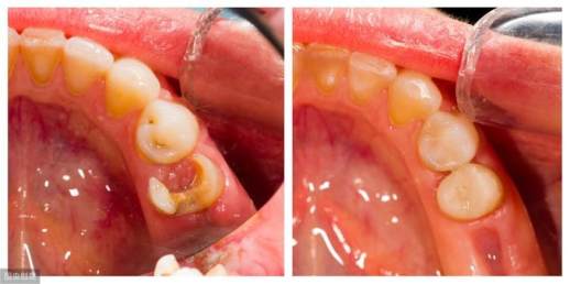 牙齿根部黑腐蚀深图片
