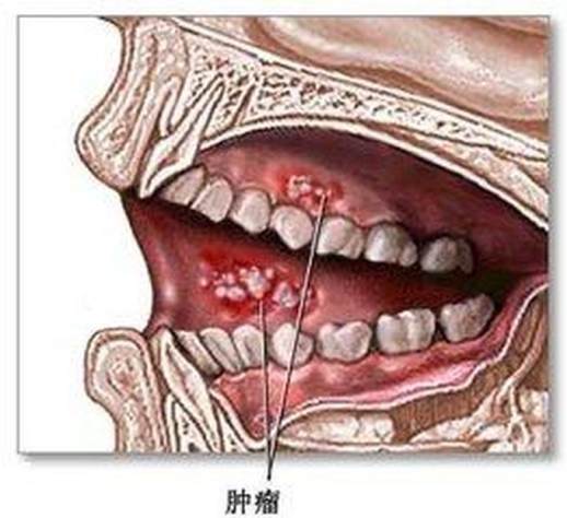 牙龈癌早期症状图片